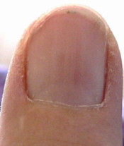 Right-Thumb-Nail-rather-distinct-red-lines-developing-7-10-07 Scaled
